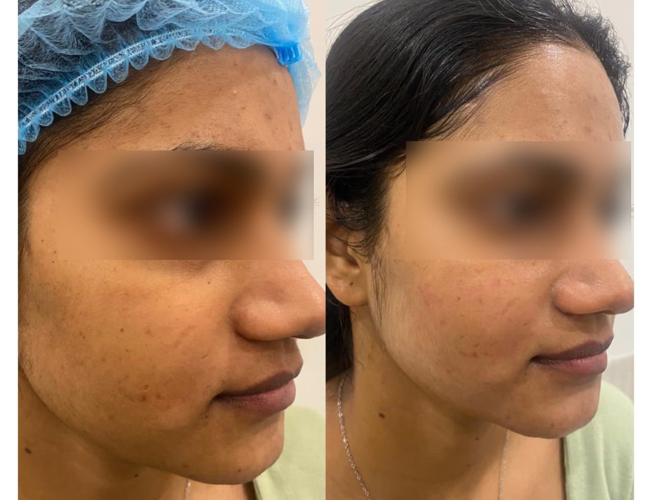 Carbon Facial