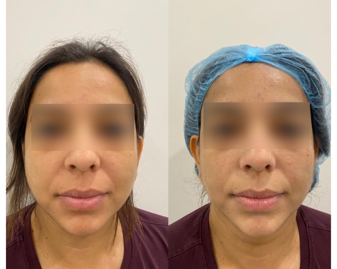 Face Laser Hair Reduction