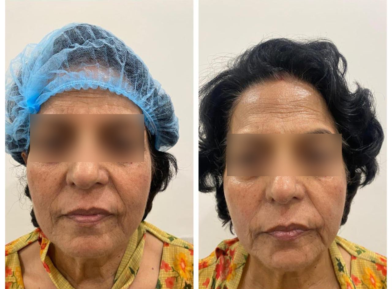 Facelift (Myolift)