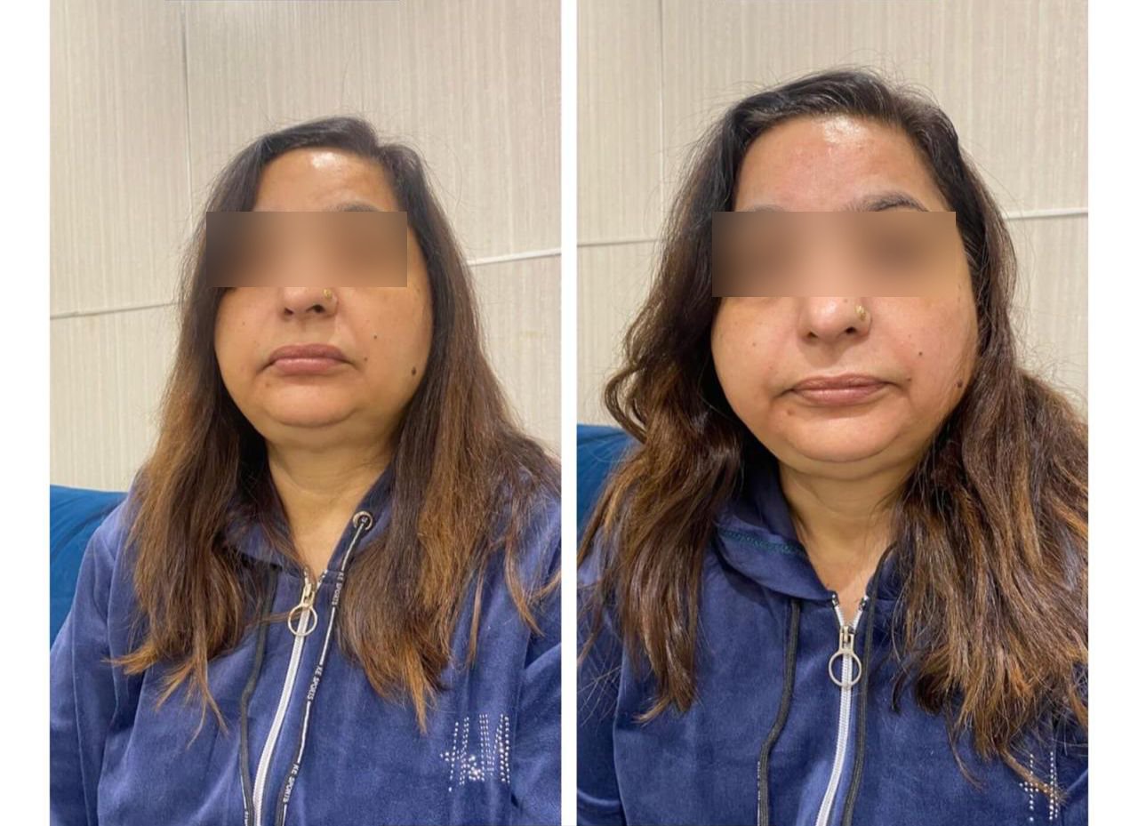 Hydra facial