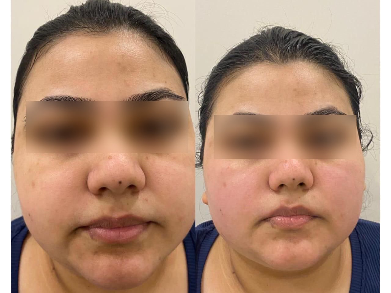 Photo facial or IPL