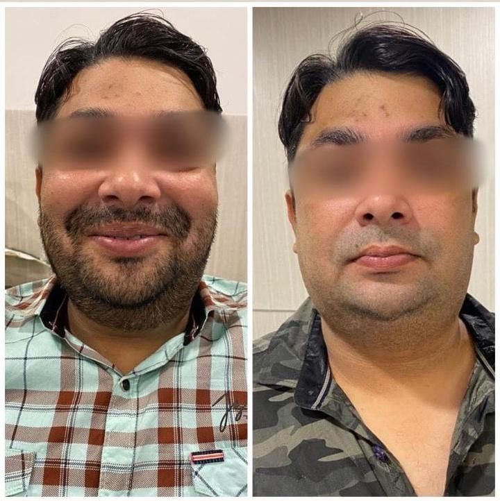 RF Doublechin reduction